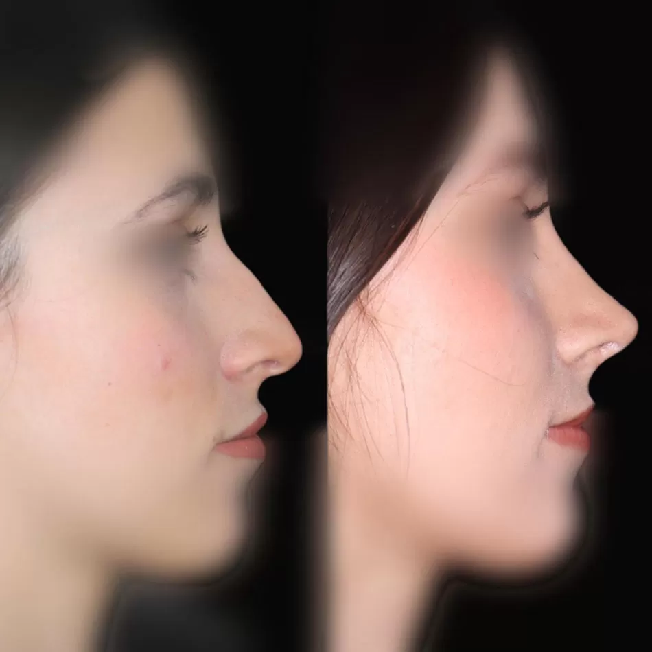 resultados rinoplastia en mijas